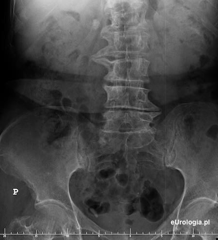 Duży zł&oacute;g w moczowodzie