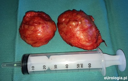 Gruczolak prostaty  - adenomektomia
