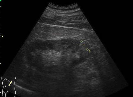 Angiomyolipoma - naczyniakomięśnaikotłuszczak