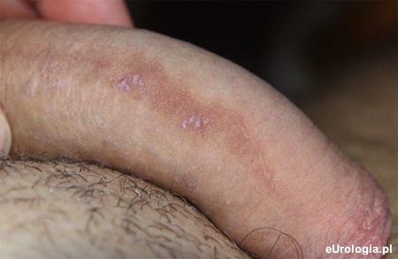 Białe plamki na skórze penisa