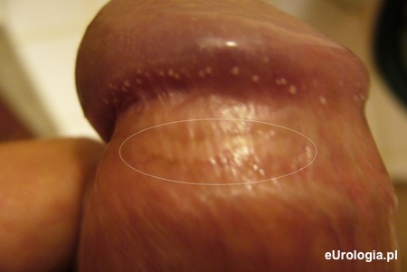 Biała plama na penisie