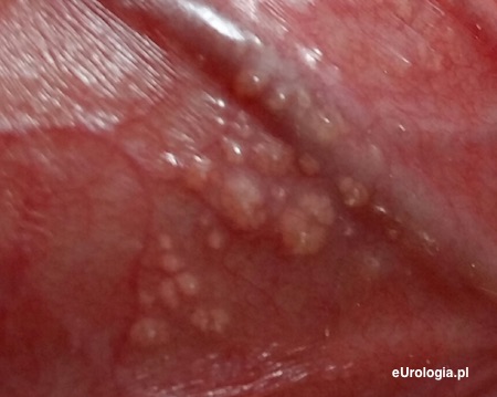 Białe plamki na penisie