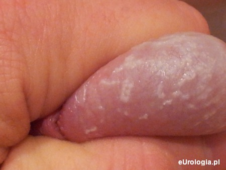 Białe plamy na żołędziu