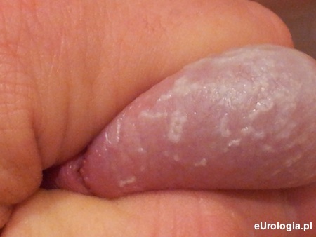 Białe plamy na żołędzi prącia - wycinki