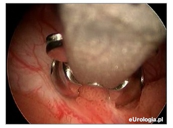 Biopsja pęcherza - widok kleszczyków biopsyjnych tuż ponad zmianą.