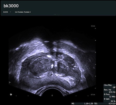 bk3000 - poprzeczny przekr&oacute;j gruczołu krokowego