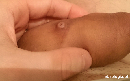 Bulwa na sk&oacute;rze penisa