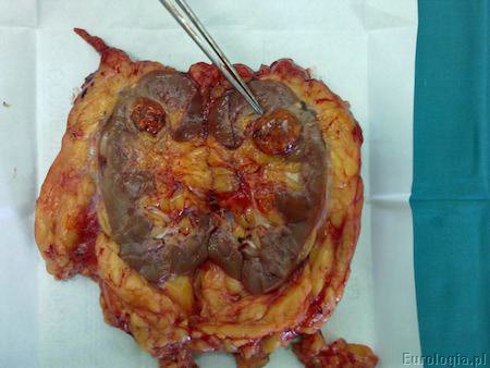 Carcinoma clarocellulare T1a