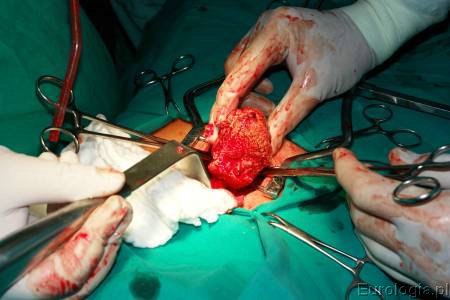 Ciało obce pęcherza moczowego i cewki - operacja