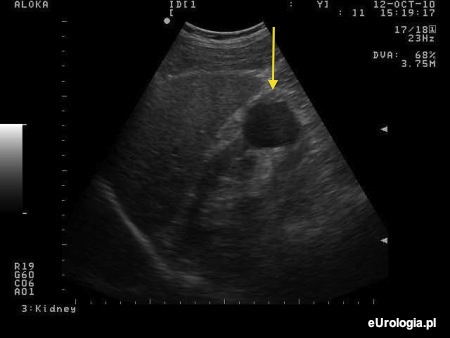 Torbiel dolnego bieguna nerki