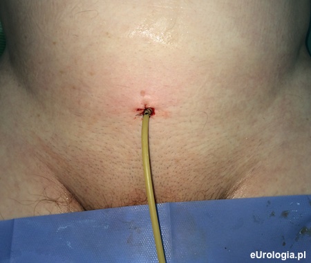 Cystsostomia - cewnik nadłonowy