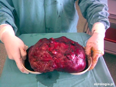 Duży guz nerki - rak jasnokom&oacute;rkowy