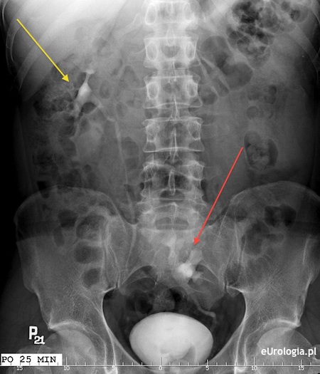 Ektopia nerki - obraz urograficzny