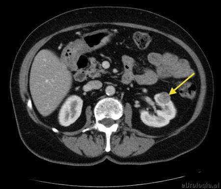 Enukleacja guza lewej nerki 2 cm