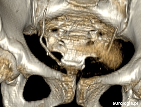 Flebolit - r&oacute;znicowanie z kamicą moczowodową