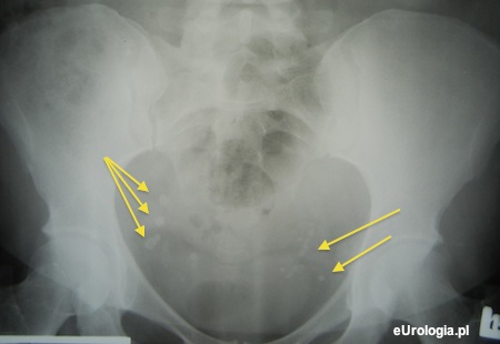Flebolity - cienie imitujące złogi w dolnym odcinku moczowodu