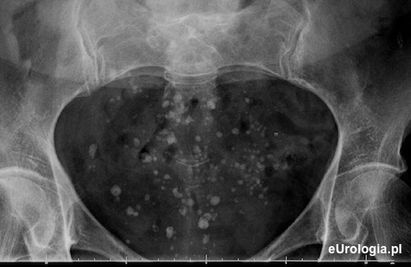 Liczne flebolity w miednicy małej