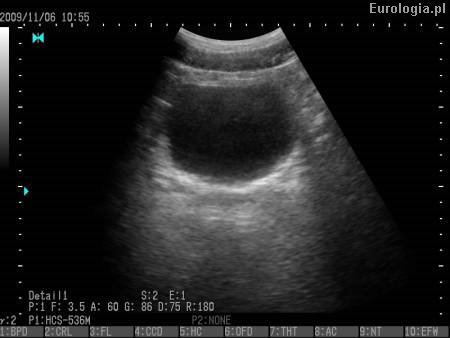 Prawidłowy pęcherz w badaniu USG