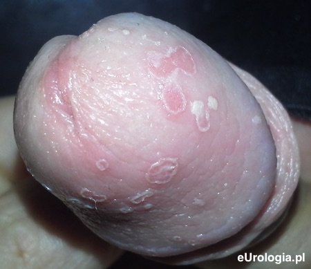 Grzybica żołędzi po antybiotykoterapii