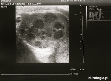 Rak jądra - liczne ogniska w USG