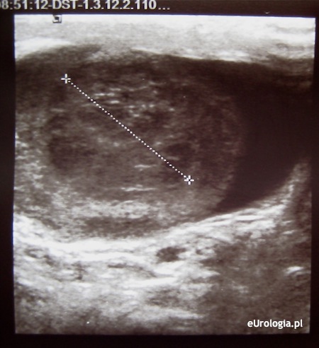 Obraz USG guza jądra