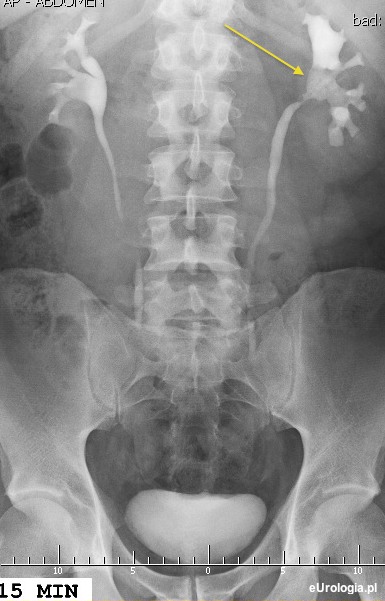 Guz miedniczki nerki lewej - ubytek w urografii