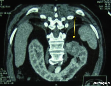 Guz lewej nerki w nerce podkowiastej.