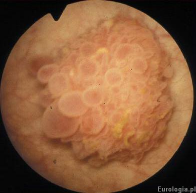 Fot. Guz pęcherza moczowego.