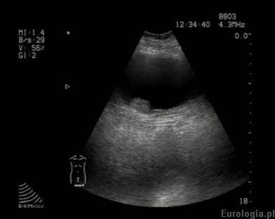 Guz pęcherza moczowego - obraz USG