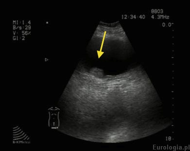 Guz pęcherza w USG