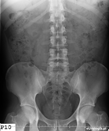 Kamica lewego moczowodu - urografia
