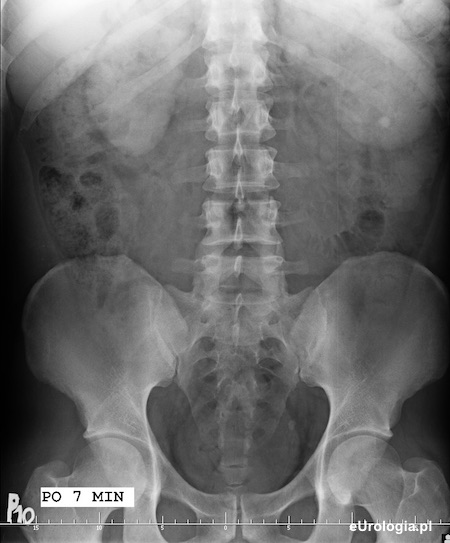 Kamica lewego moczowodu - urografia