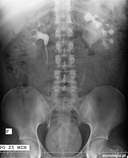 Kamica lewego moczowodu urografia. Naczynie dodatkowe.