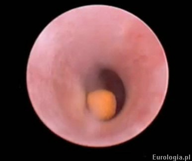 Kamica moczowodowa - URSL