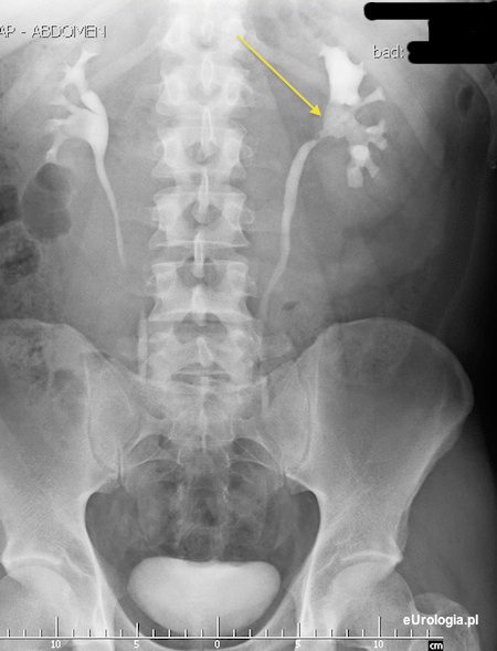 Kamica odlewowa - urografia