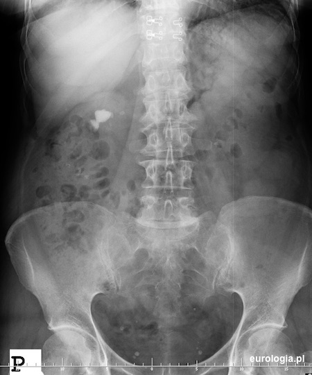 Kamica odlewowa prawej nerki w urografii