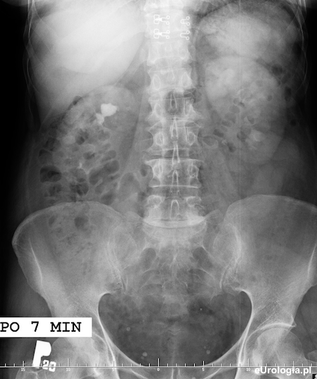 Kamica odlewowa - urografia
