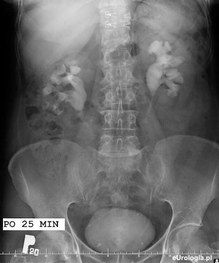 Kamica odlewowa prawej nerki i kamica połaczenia mm nerki lewej