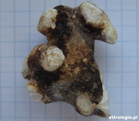 Złog odlewowy - kamica struwitowa