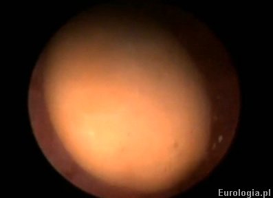 Kamica pęcherza - złóg widoczny w czasie endoskopowego usunięcia