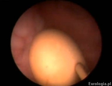 Lithotrypsio et litholapaxio calculi vesicae urinariae