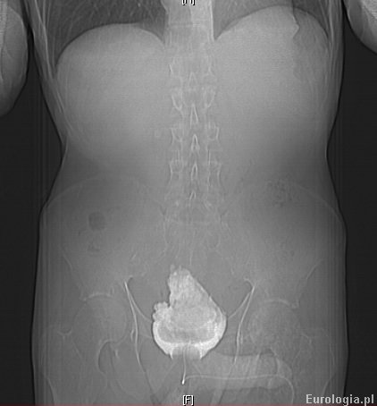 Kamica pęcherza - tomografia komputerowa