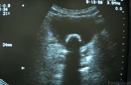 Kamień w pęcherzu moczowym - USG