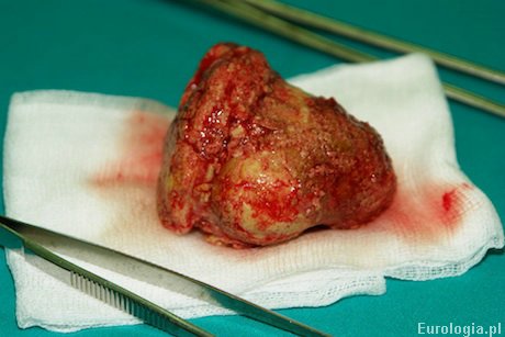 Kamień wydobyty z pęcherza moczowego