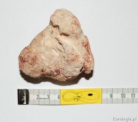 Kamica pęcherza moczowego