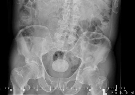 RTG przeglądowe - kamień moczowy w pęcherzu