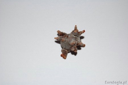 Kamica pęcherza moczowego