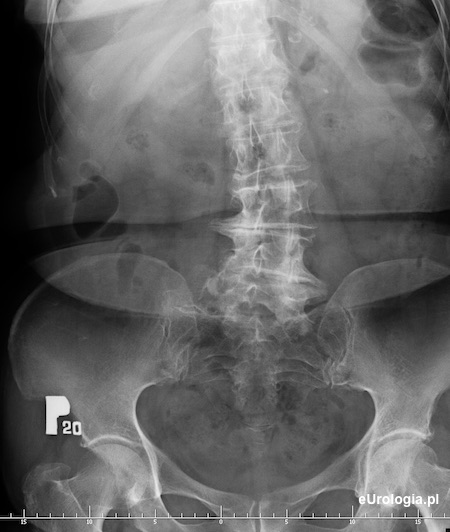 Kamień w moczowodzie L5/S1