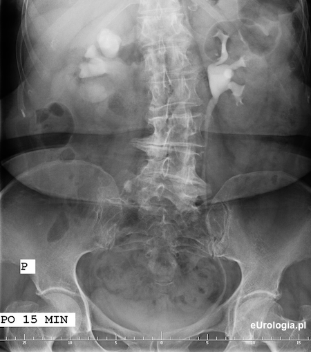 Kamica g&oacute;rnego odcinka prawego moczowodu