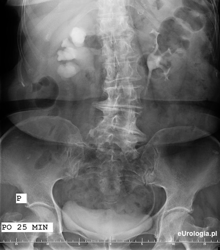 Kamica prawego moczowodu